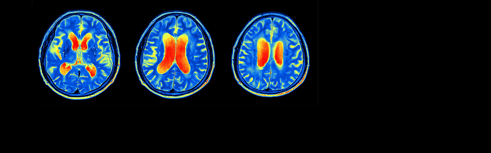 MRI scans of a brain.