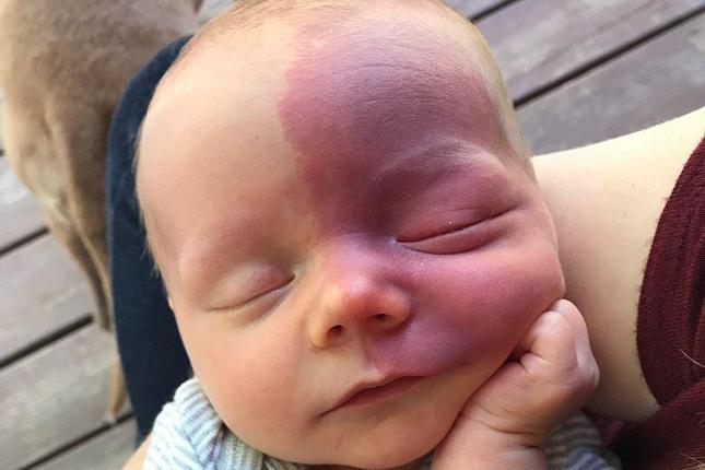 Un bebé con síndrome de Sturge-Weber durmiendo una siesta en brazos.